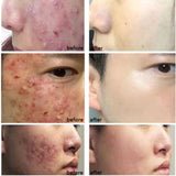 Acne Spot Gel