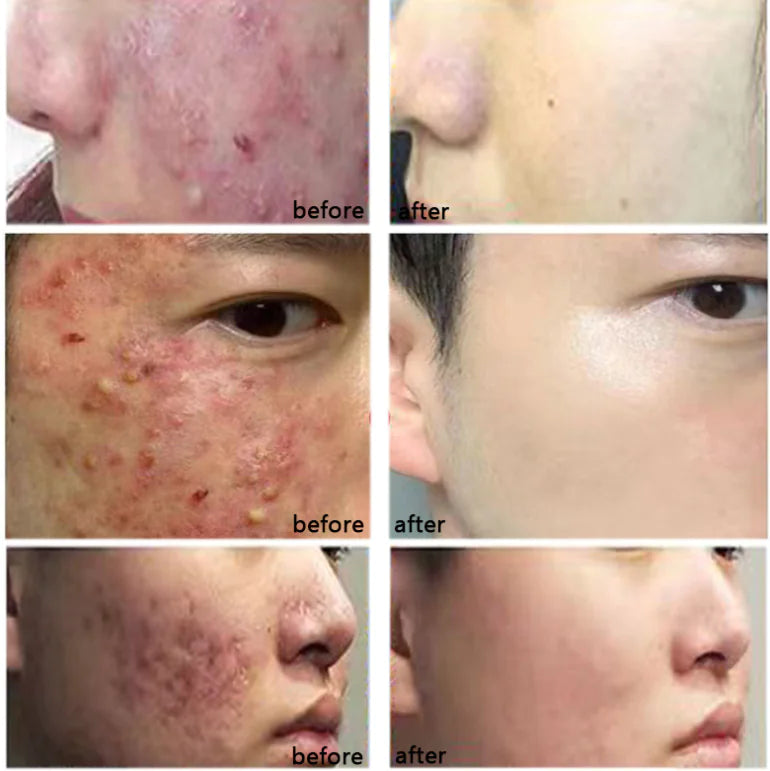 Acne Spot Gel