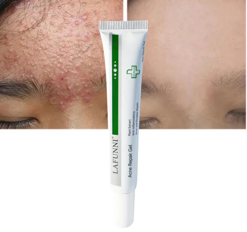 Acne Spot Gel