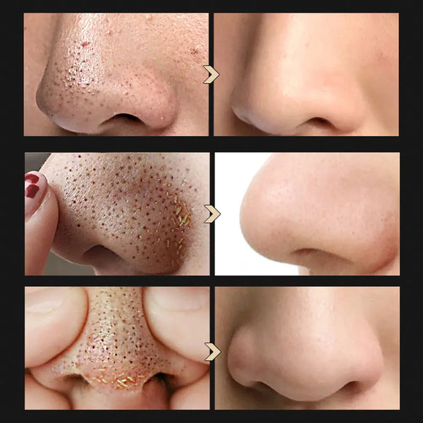 BREYLEE Blackhead Removal Mask and Essence Set